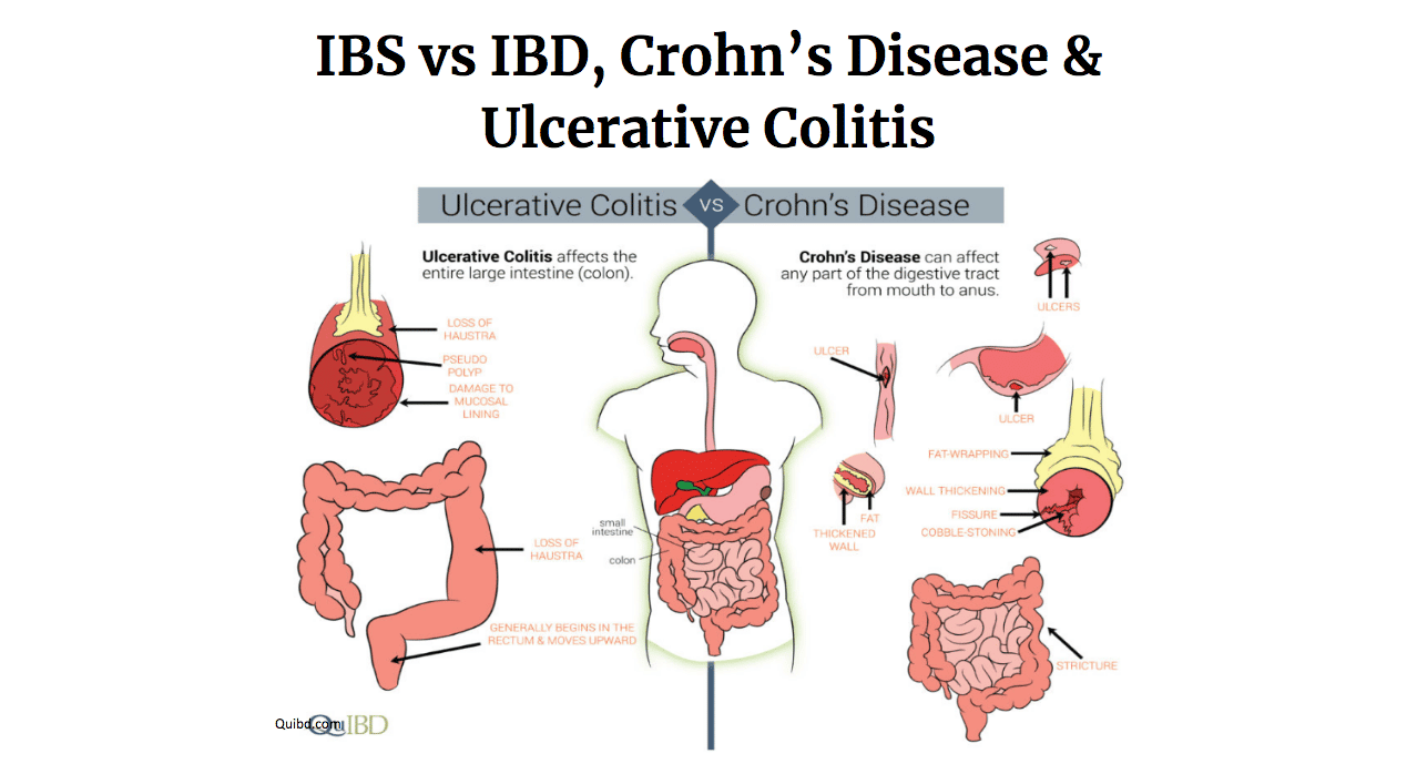 IBS IBD Crohns UC