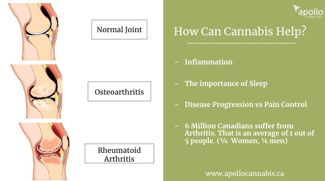 How can cannabis help with arthritis?